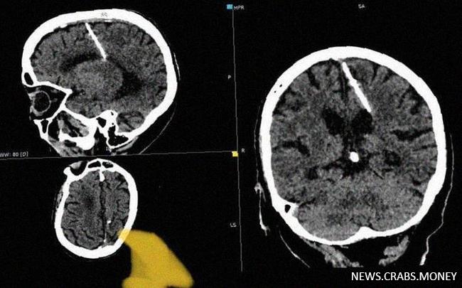 У пенсионерки на Сахалине обнаружили иглу в мозгу, с которой она жила всю жизнь