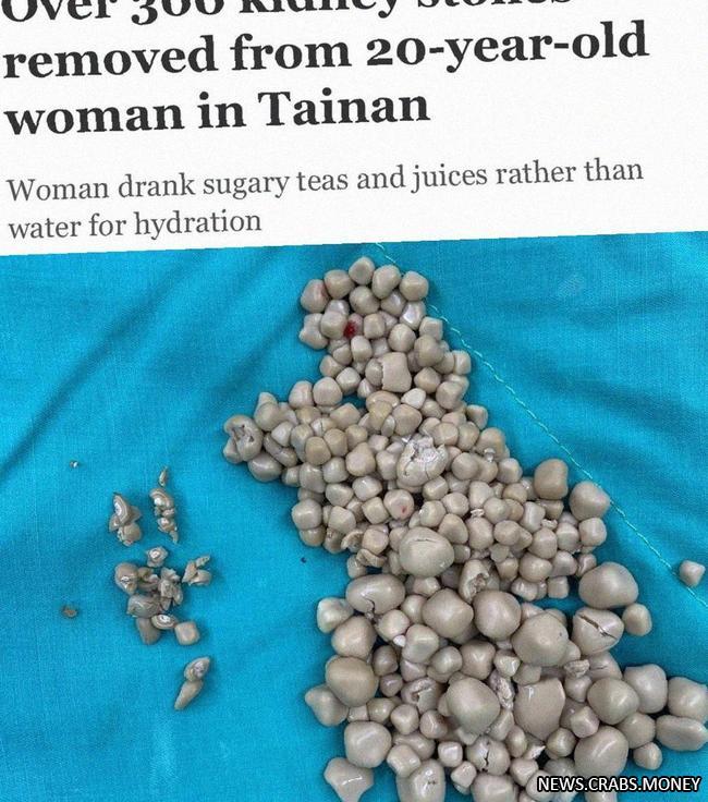 Девушка из Тайваня удалила 300 камней из почек из-за питания