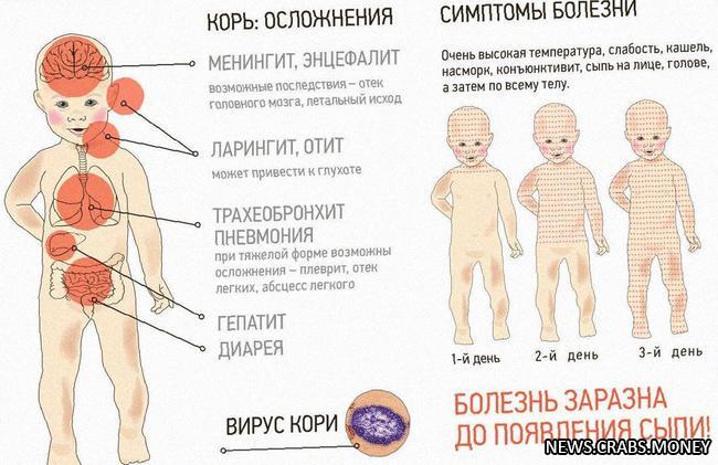 123 случая завоза кори в Россию: вирусы пришли из 16 разных стран